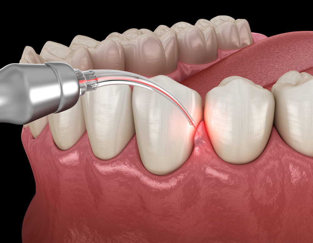 Gum Care & Surgeries